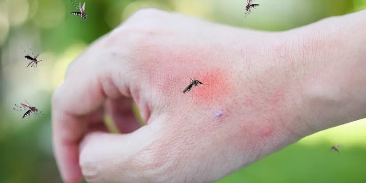 Sivrisinek ısırığının kaşıntısı nasıl geçer?