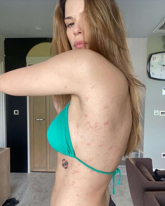 Larissa Gacemer hastalığını sosyal medyadan duyurdu