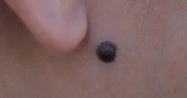 Benlerdeki değişime dikkat: Kanser belirtisi olabilir