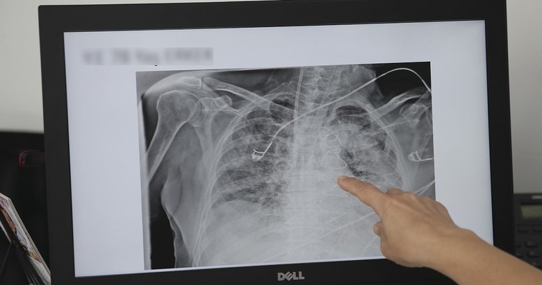 Bilim Kurulu Üyesi Turan’dan korkutan açıklama: Virüsün akciğer hasarı inanılmaz