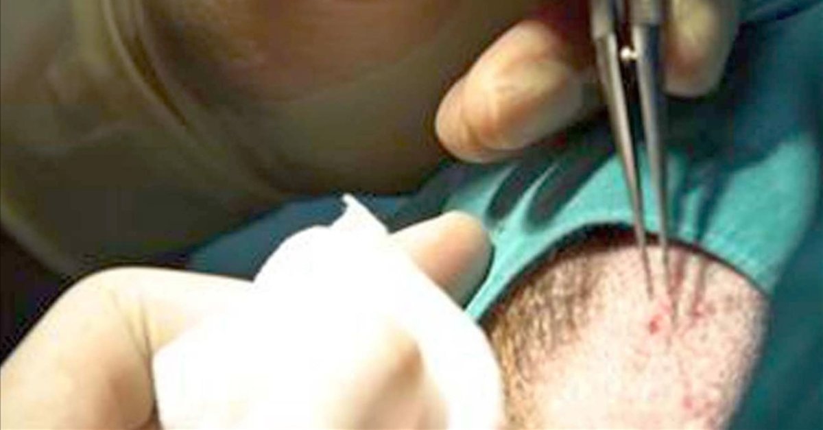 Trabzon'da korkunç olay! Sadece saç ekimi yaptırmak istemişti: Öldü