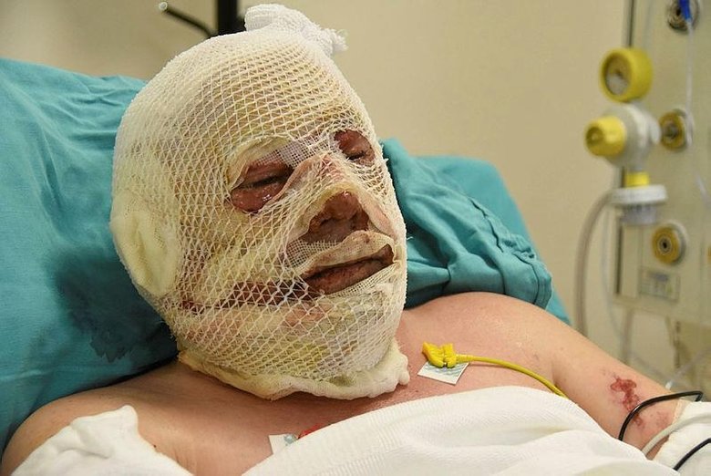 Yangınla savaşırken alevler arasında kaldı! Yaşadığı dehşet anlarını böyle anlattı