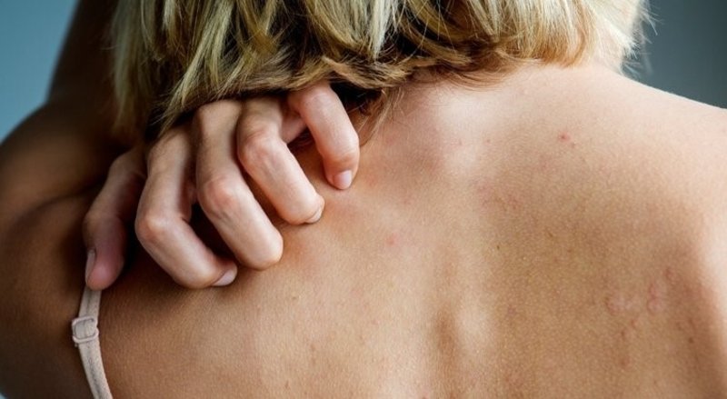 uyuz hastaligi belirtileri nedir uyuz