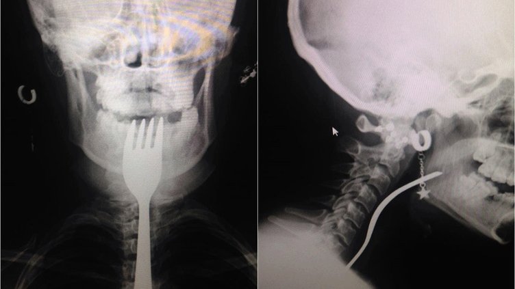 Aydın’da çatal yutan kız makaleye konu olacak