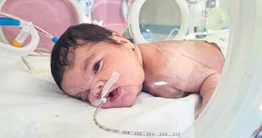 Minik Eymen’in boynundan 445 gram tümör çıkarıldı