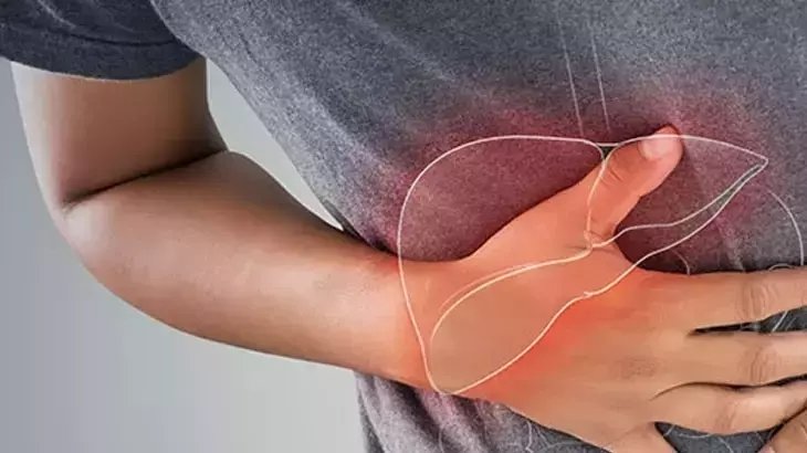 Siroz nedir? Siroz hastalığı belirtileri nelerdir? Tedavisi var mıdır?