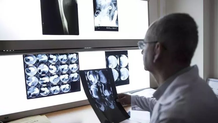 Epilepsi nedir? Epilepsi belirtileri nasıl anlaşılır? Semptomları neler?