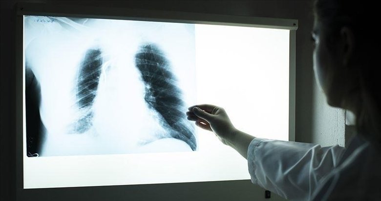 Tüberküloz bulaşıcı hastalıklara bağlı ölümlerde ikinci sırada