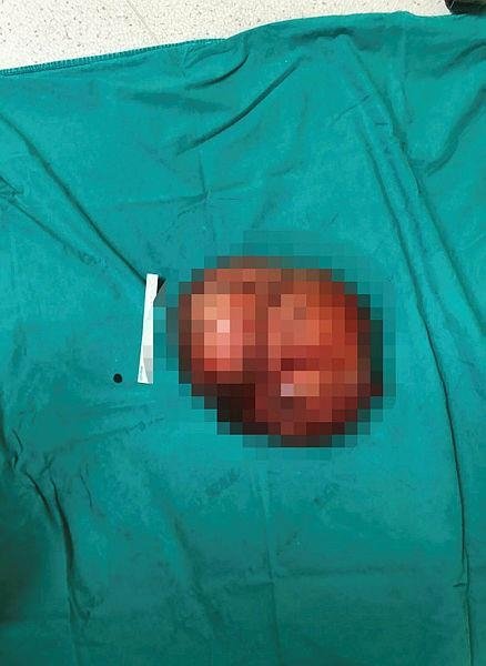 Karınlarındaki kitlelerden aynı gün kurtuldular