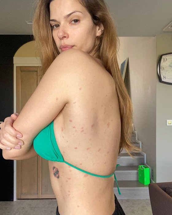 Larissa Gacemer hastalığını sosyal medyadan duyurdu