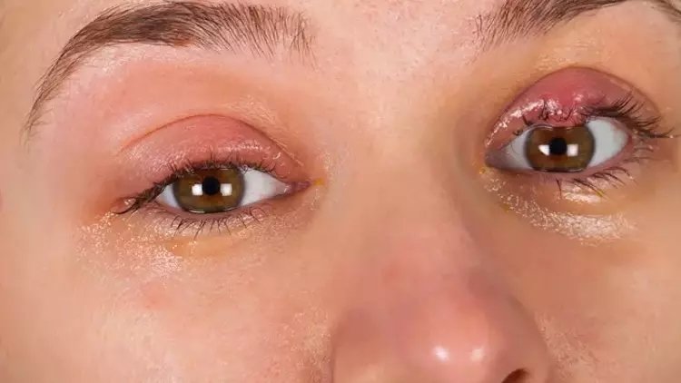 Arpacık nedir? Neden çıkar? Arpacık tedavisi nasıl yapılır?