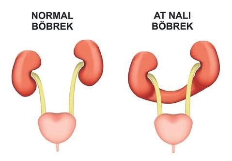 Nadir görülen at nalı böbreği Ekol Hastanesi’nde tedavi edildi