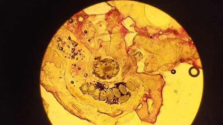 Duştan sonra şiddetli kaşınanlar dikkat! Uyuzun habercisi olabilir