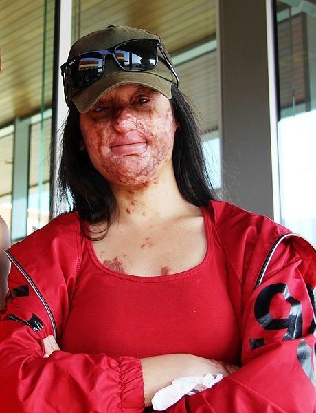 Berfin, 12 saat süren zorlu ameliyattan çıktı