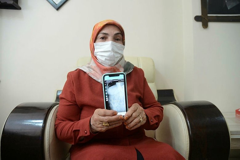 Ameliyatta hastanın karnında makas unutuldu