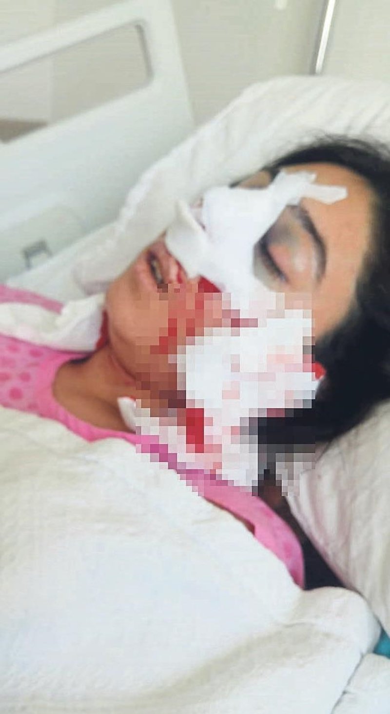 Burun Ameliyati Komaya Soktu