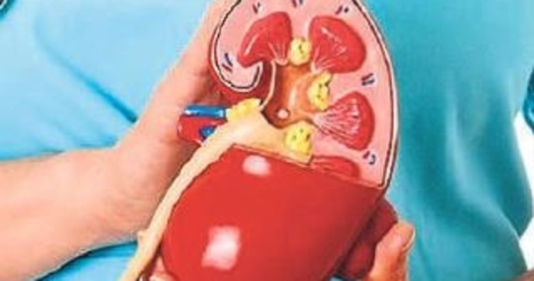 bobrek taslari hakkinda dogru sanilan 6