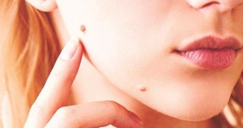 Leke ve benlere dikkat etmelisiniz