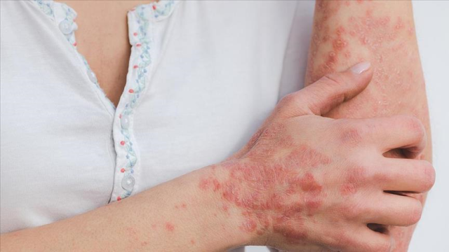 Gül hastalığı nedir, belirtileri nelerdir? Gül hastalığının nasıl tedavi edilir?