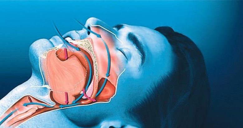 Uyku apnesine ne iyi gelir?