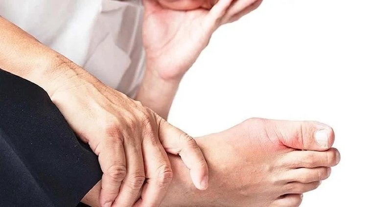 Gut hastalığı nedir, belirtileri nelerdir? Gut hastaları nasıl beslenmeli?