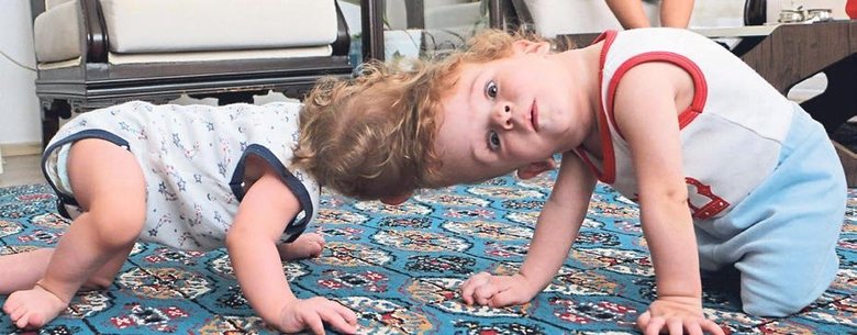 Antalyalı siyam ikizleri İngiltere’de ayrıldı