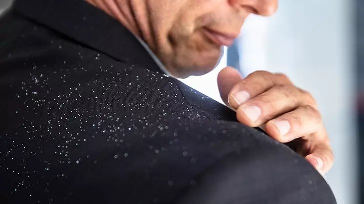 Saç kepeğini görmezden gelmeyin! O hastalığın habercisi...