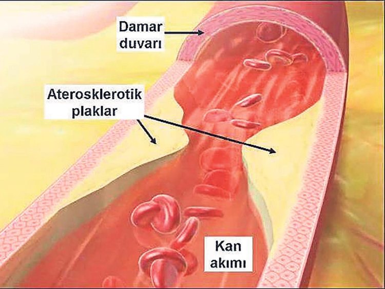 Cerrahi müdahale olmadan tıkalı damar açılabiliyor