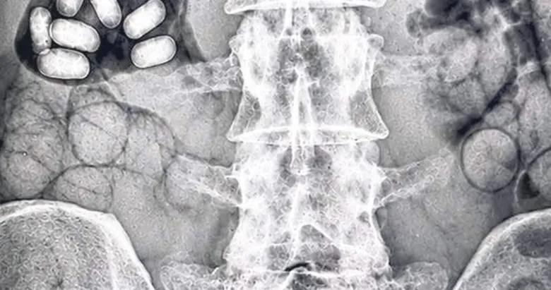 Midelerinden 495 gram uyuşturucu çıktı