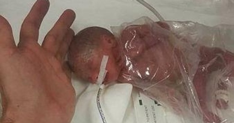 Mucize bebek İdil, yaşama tutundu