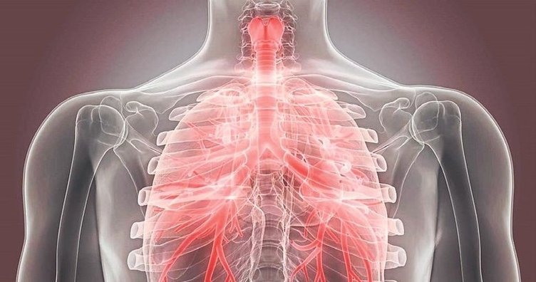 Bronşit nedir, belirtileri nelerdir? Nasıl geçer?