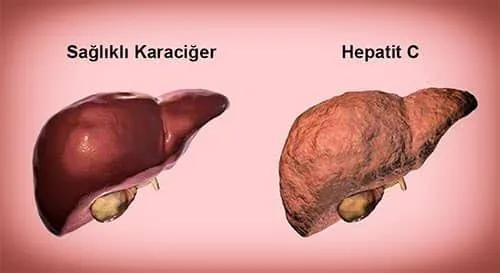 hepatit-c-icin-hayati-uyari-1785182817927.png
