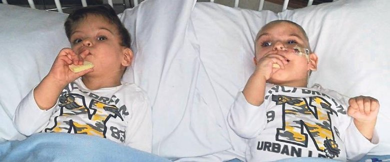 Antalyalı siyam ikizleri İngiltere’de ayrıldı