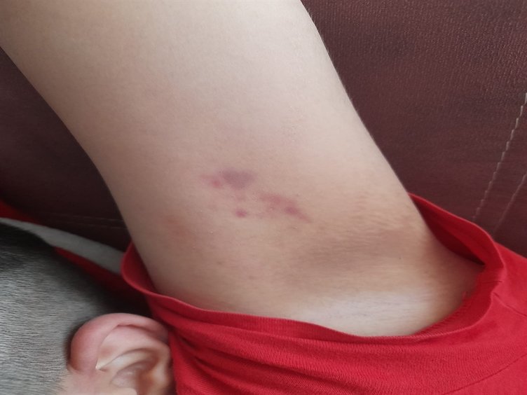 Otizmli vücudunda 54 morluk bulundu! Savcılık soruşturmasında sınıf öğretmeni açığa alındı