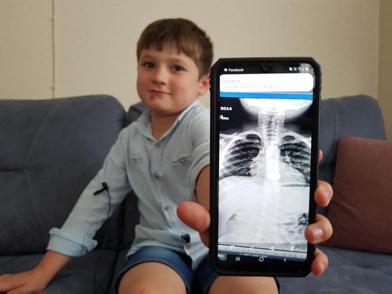 İzmir’de yaşayan 6 yaşındaki çocuğun boğazına bozuk para kaçtı