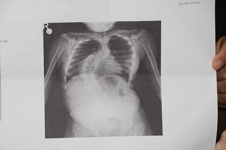Skolyoz hastası Kardelen’den yardım çağrısı