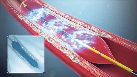 Kireçli kalp damarlarının açılmasında yeni teknoloji