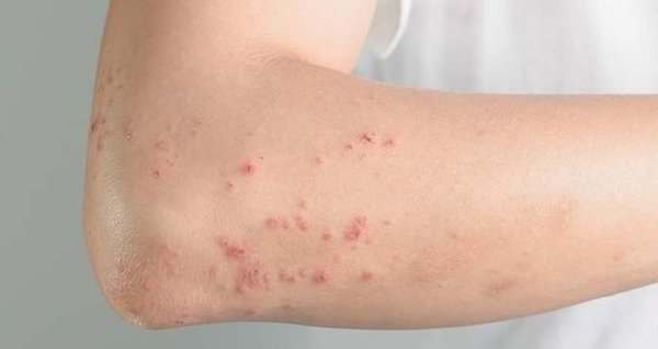 Zona hastalığı nedir, belirtileri nelerdir? Zona hastalığı tedavisi var mı?