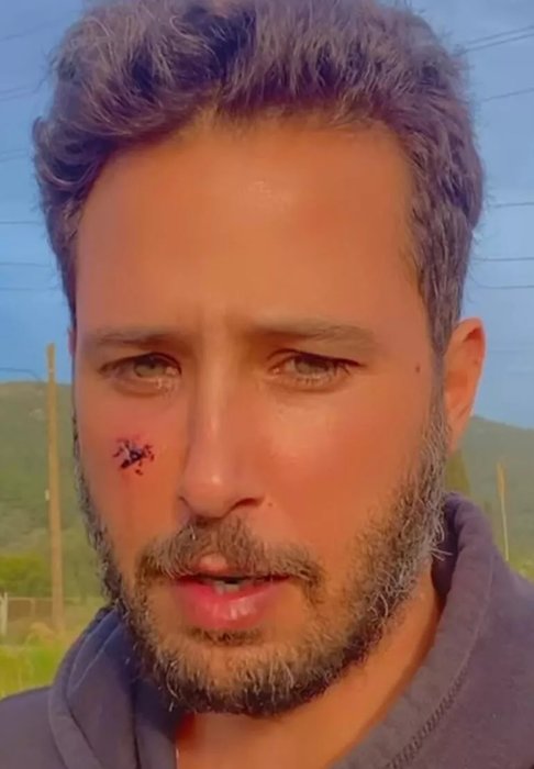 Ünlü oyuncu Tuan Tunalı köpek saldırısına uğradı