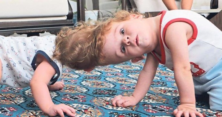 Antalyalı siyam ikizleri İngiltere’de ayrıldı