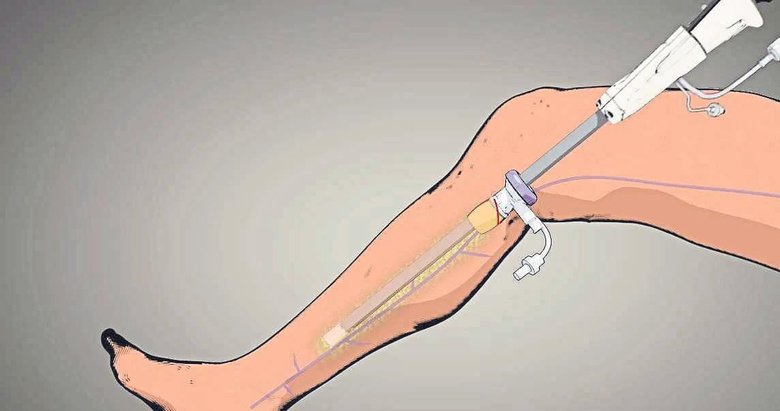 ‘Koroner By-Pass’a kozmetik çözüm