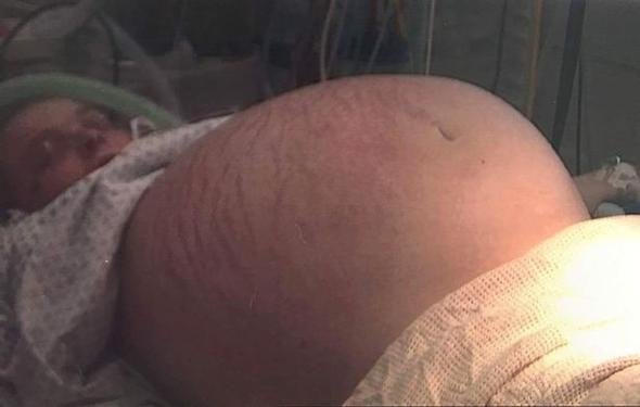 Doktorlar bile hamile sandı! Çıkanlara kimse inanamadı...