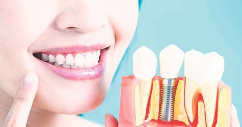 Eksik dislere basarılı çözümler: Dental implant