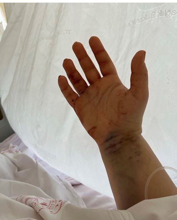 Eşi tarafından 32 kez bıçaklanmıştı! Youtuber Merve Veziroğlu’ndan paylaşım geldi