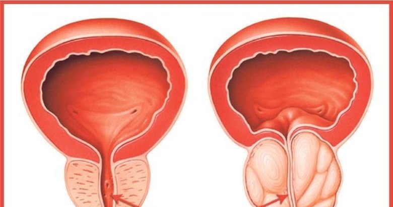 Genetik yatkınlık prostat kanserini artırıyor