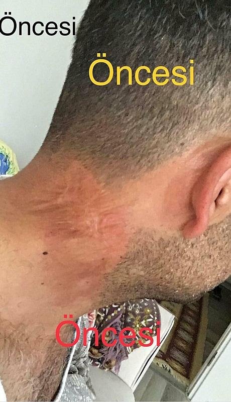 Lazer tedavisi sonrası hayatı karardı! Soluğu mahkemede aldı