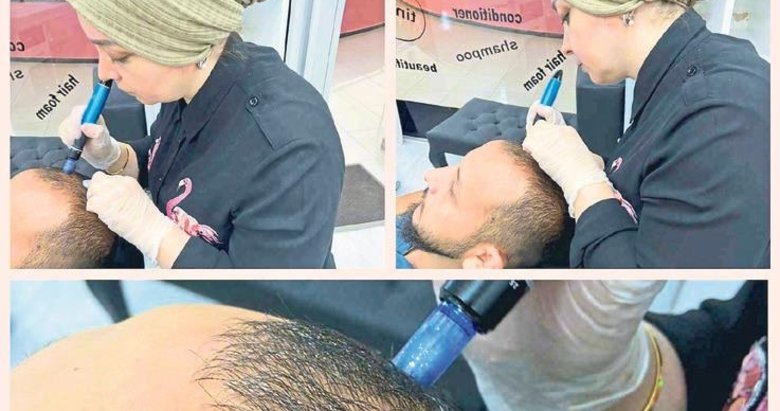 Saç dökülmesinin acısız ve ağrısız çözümü mümkün