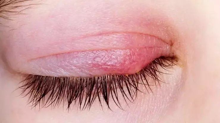 Arpacık nedir? Neden çıkar? Arpacık tedavisi nasıl yapılır?