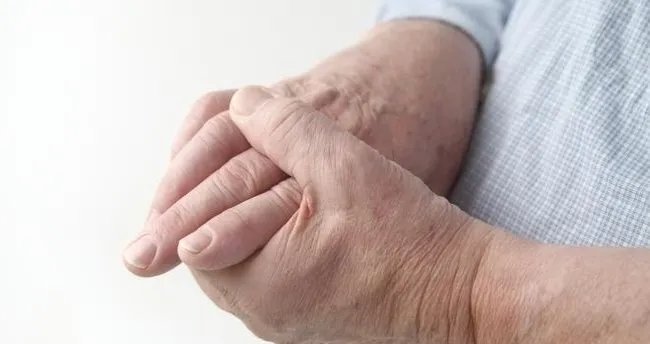 Artrit nedir, neden olur? Artrit belirtileri nelerdir?