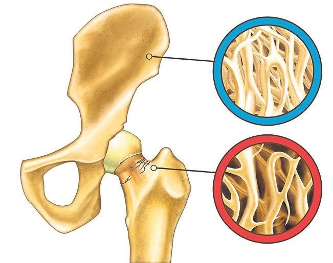 Beslenme düzenini değiştir kemik erimesinden korun